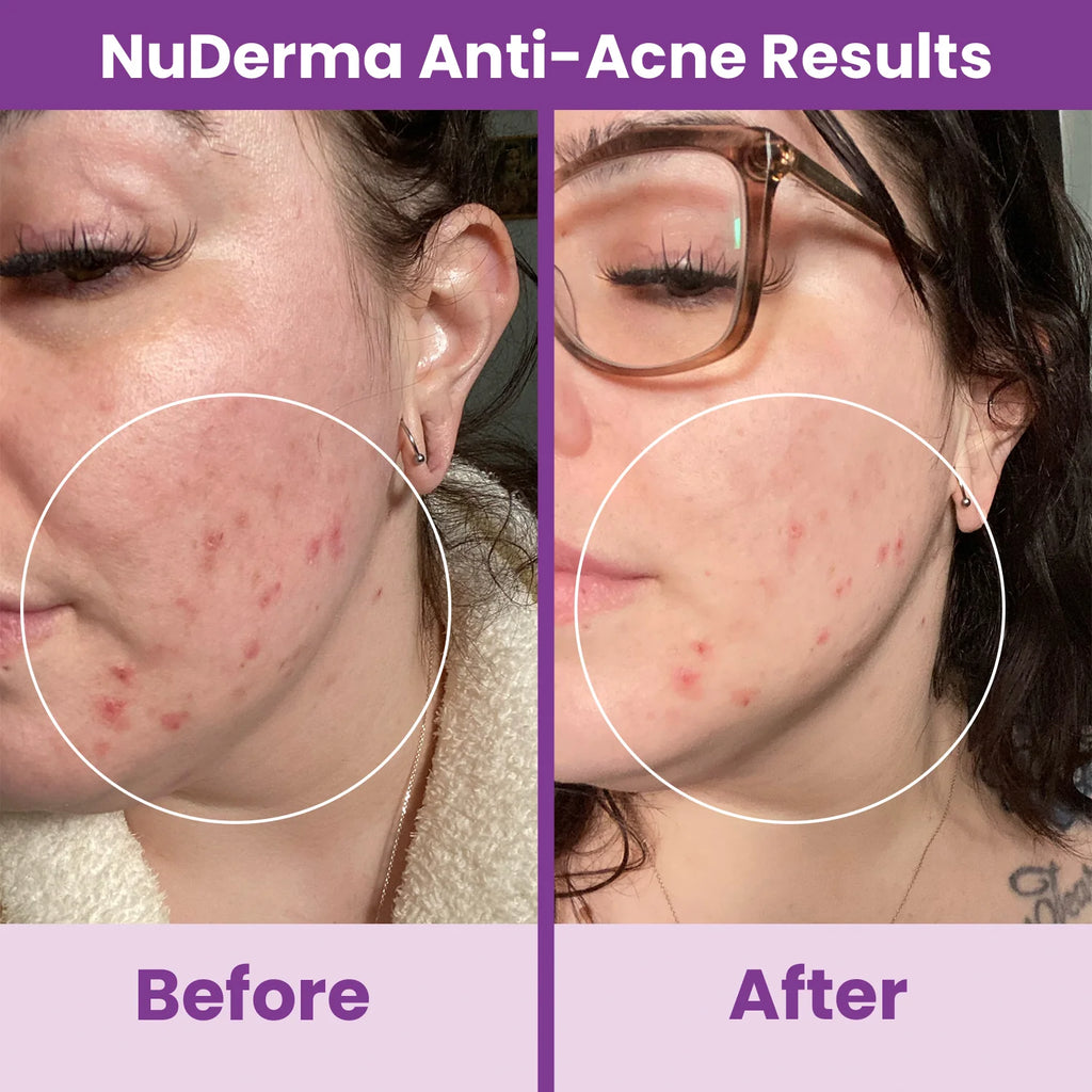 Nuderma Standard High Frequency Wand