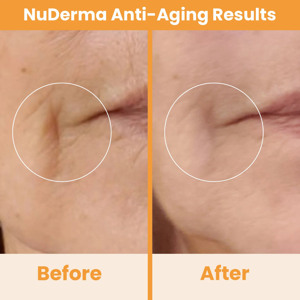 Nuderma Standard High Frequency Wand