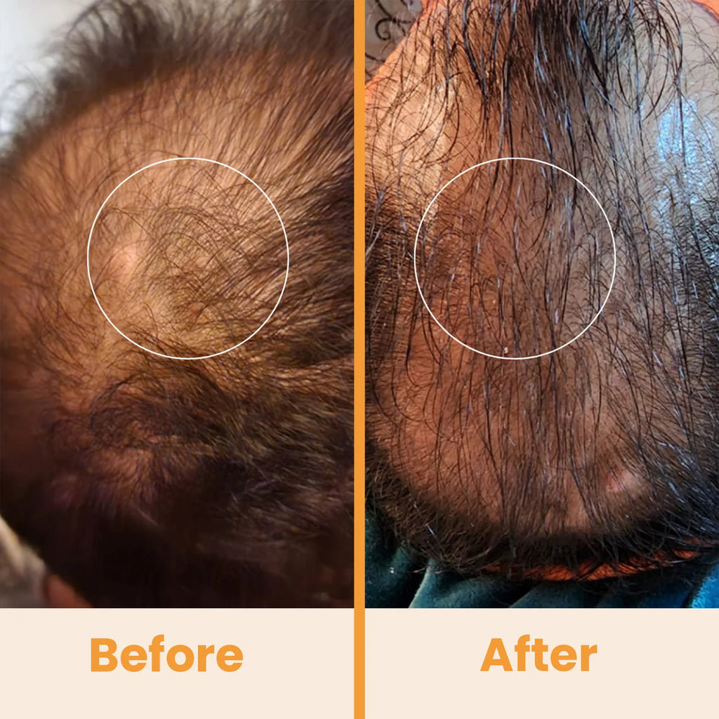 Nuderma Standard High Frequency Wand